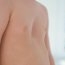 Pectus excavatum: cauze, simptome și tratament