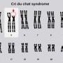 Sindromul Cri du chat: cauze, simptome si tratament