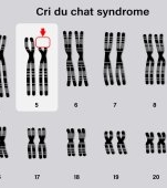 Sindromul Cri du chat: cauze, simptome si tratament