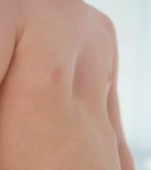 Pectus excavatum: cauze, simptome și tratament